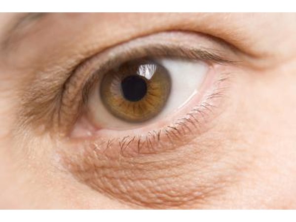 A condition known as blepharitis (inflamed eyelids) sometimes prevents the lower lids from producing the substance that allows tears to spread smoothly over the entire eye.