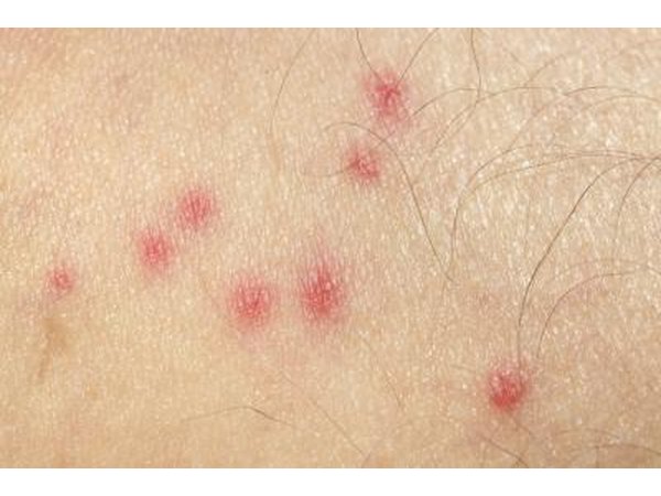 Alternate bug bites.