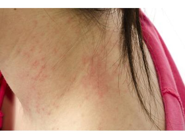 Young woman with a rash on her neck