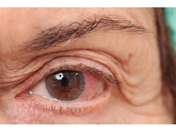Pink eye.