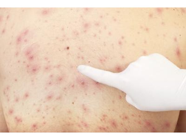 Chicken pox may recur.