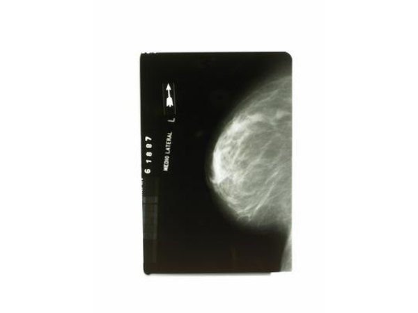 Xray of breast