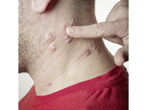 Shingles is a rash due to the virus that causes chickenpox
