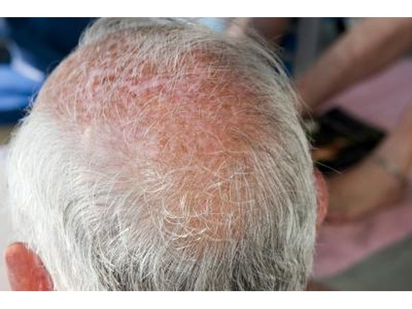 If you have bald spots and itching on the scalp, you may also have a fungal infection called tinea capitis aka ring worm