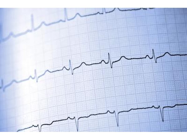 EKG reading