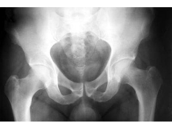 X-ray of pelvis bone