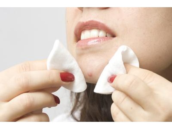 Acne can be viewed as a rash.