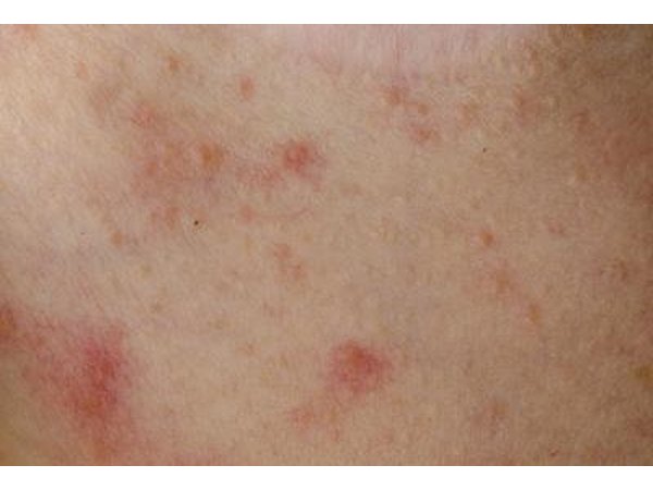 Dermatitis, psoriasis, eczema, burns and skin injuries often damage hair.
