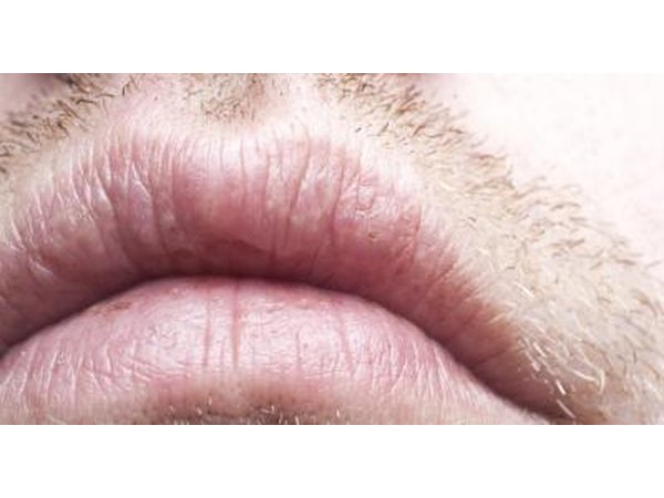 Dry mouth
