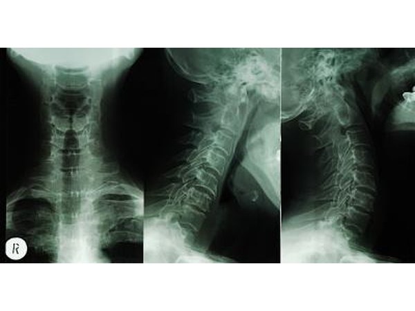 Rheumatoid arthritis commonly affects the vertebrae of the neck.