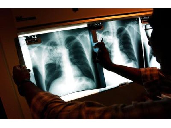 X-rays of tuberculosis affecting a patient's lungs