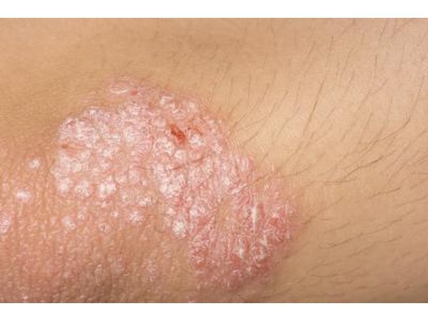 An eczema skin rash.