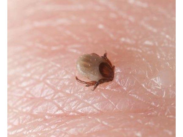 Reddened skin with tick.