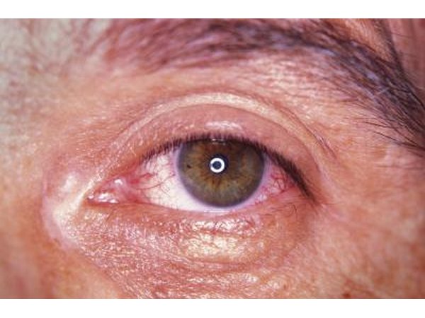 Eyes may become red and swollen.
