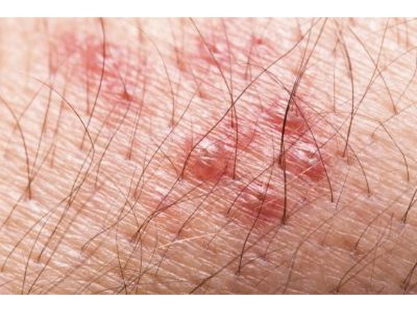 Herpes can be itchy.