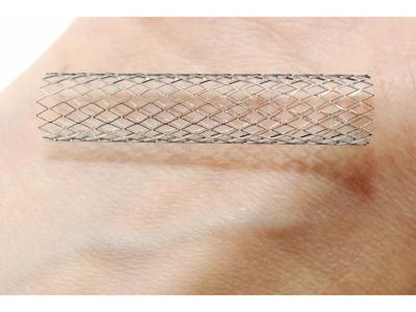 A stent.