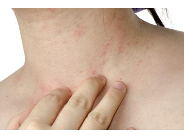 Young individual with an allergy rash