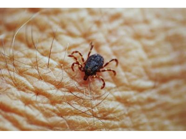 A close-up of a tick on human skin.