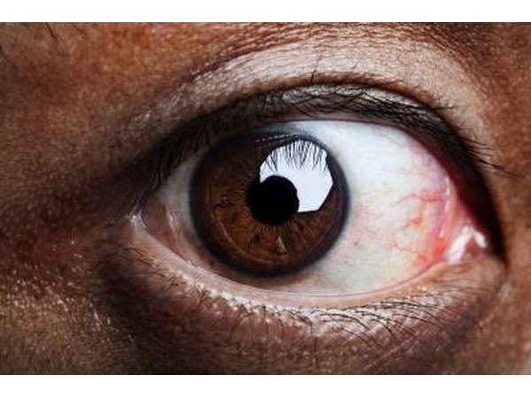 Close up of red eye.