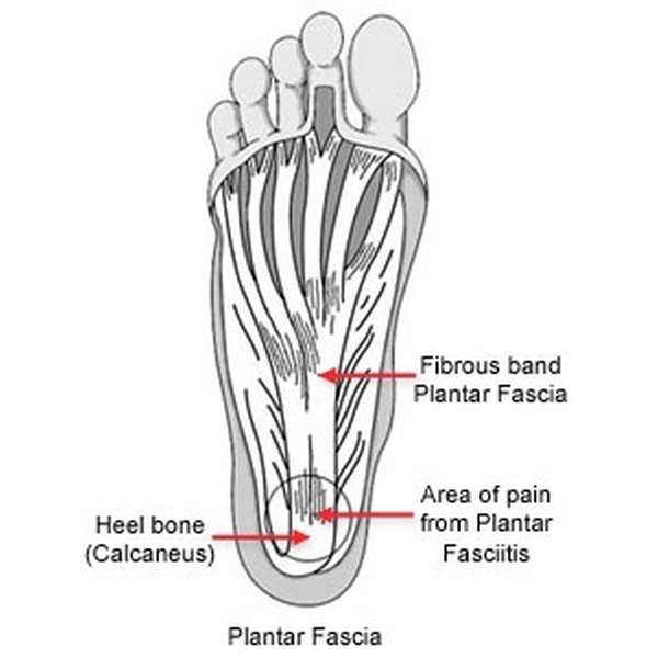 How to Do Sports Massage for Plantar Fasciitis Healthfully