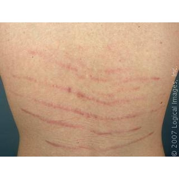 what-causes-stretch-marks-on-the-lower-back-healthfully