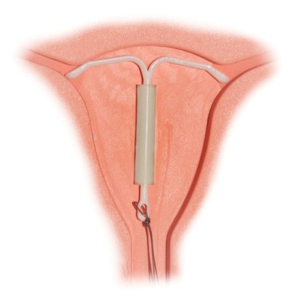 problems-with-mirena-iud-healthfully