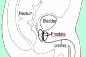 ciprofloxacin dose for prostatitis