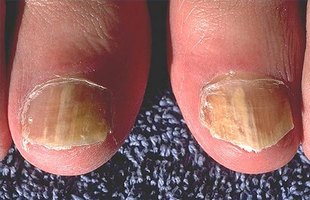 Is bleach an effective treatment for toenail fungus?