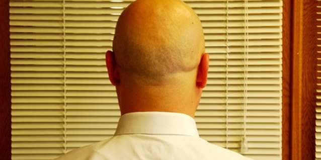 Bald man from backside image by TekinT from Fotolia.com Laser hair combs are purportedly ineffective for severe male pattern balding.