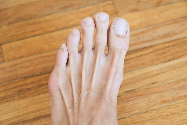 how-to-remove-dark-spots-from-toes-with-pictures-ehow