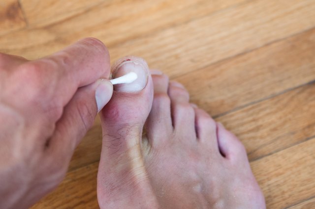 How To Fix A Split Toenail with Pictures EHow