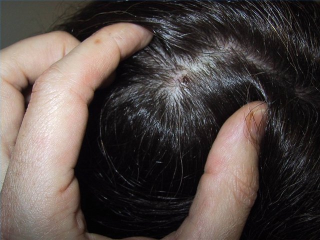 Scalp Diseases Scalp Diseases