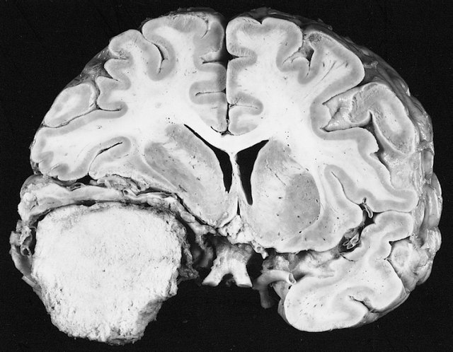 A diet with plenty of fruits and vegetables helps to shrink meningiomas. A diet with plenty of fruits and vegetables helps to shrink meningiomas.