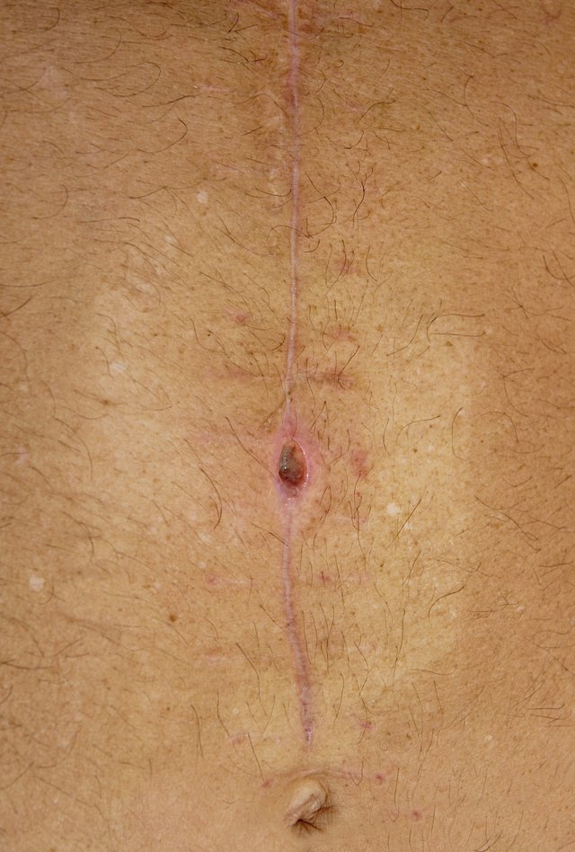 Staph infection. Staph infection.