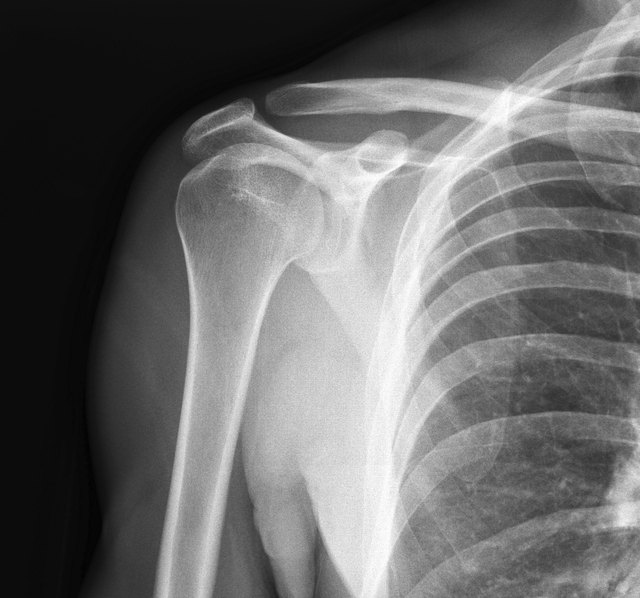 An X-ray will show more detail.