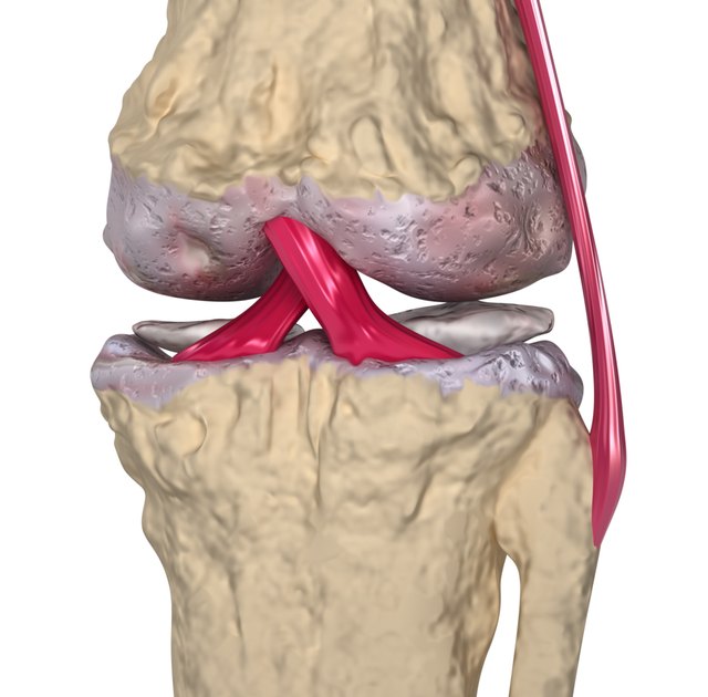 3D model of osteoarthritis of the knee.