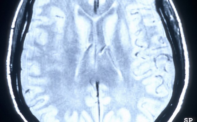 Depression is believed to be the result of a chemical imbalance in the brain.