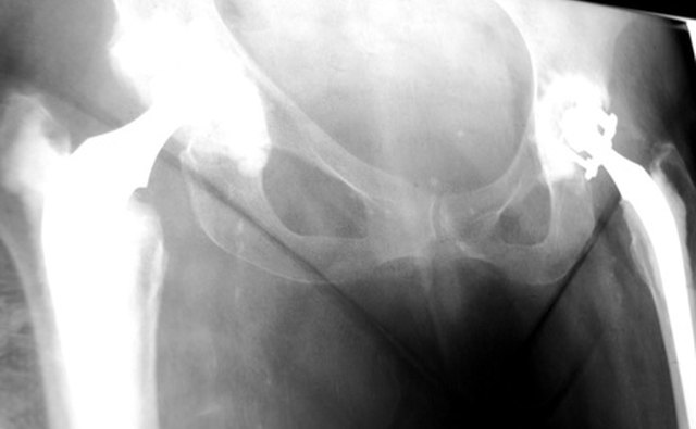 Dynamic hip screws compacts the damaged bone together.