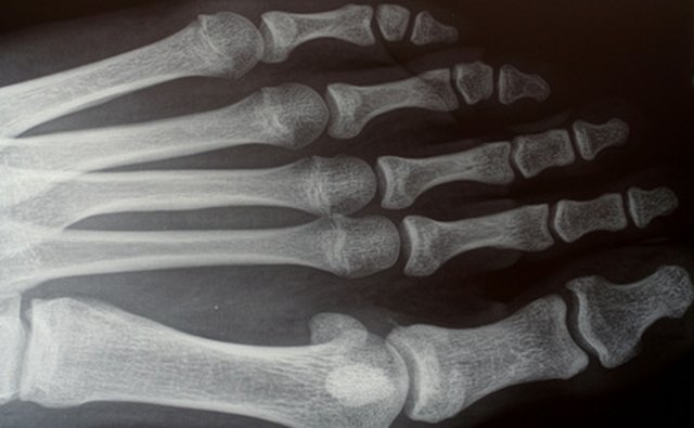 The Herbert screw is used to hold small fractured bones as in feet and hands.