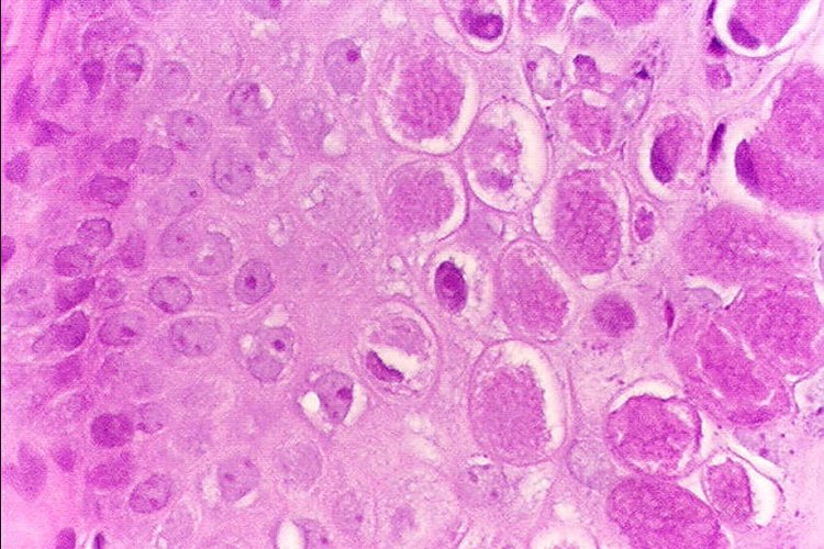 Molluscum contagiosum.