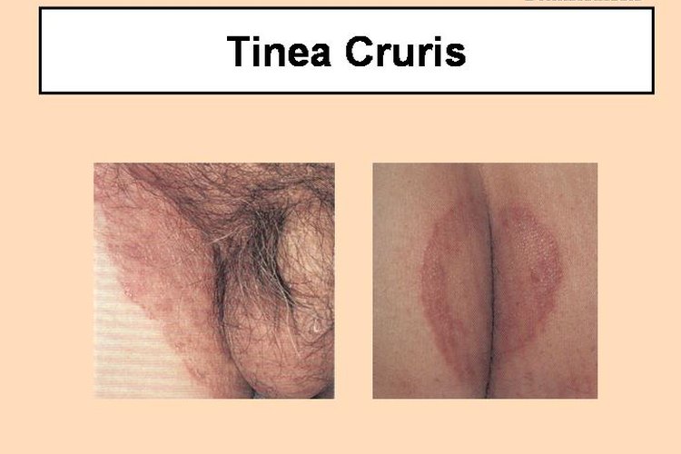 Cómo identificar los síntomas de la tiña inguinal.