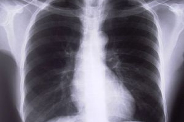 Rayos X de los pulmones.
