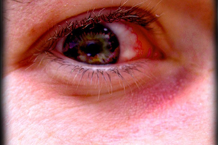 Conjuntivitis viral.