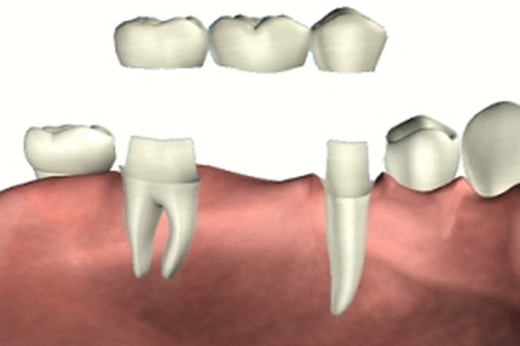 Es necesario que limpies la parte inferior del puente dental.