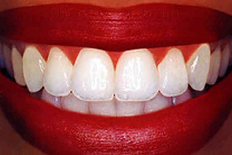 Deshacerse de las caries.