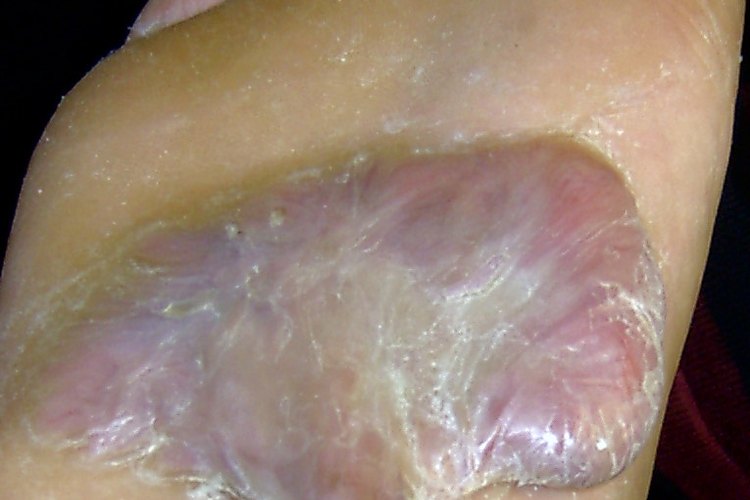 Los queloides pueden desarrollarse en cualqueir parte del cuerpo.