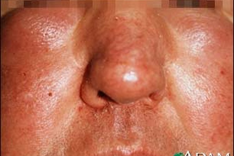 La hinchazón facial puede aliviarse con remedios caseros.