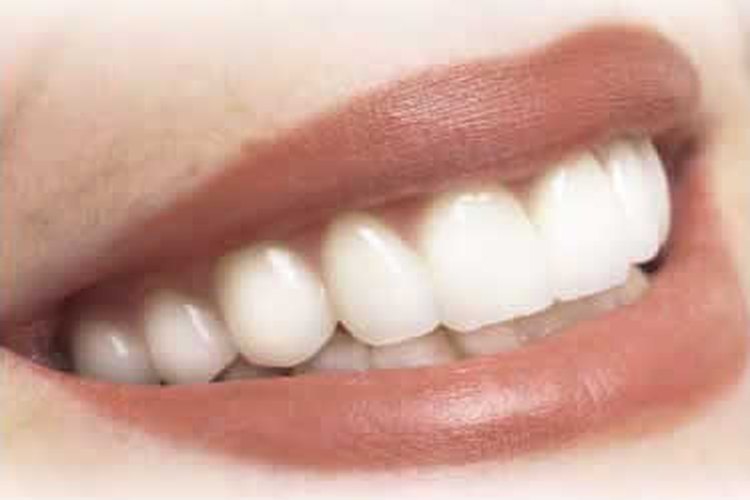 Limpia los implantes dentales a menudo.