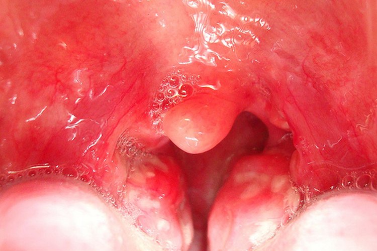 Amigdalitis.