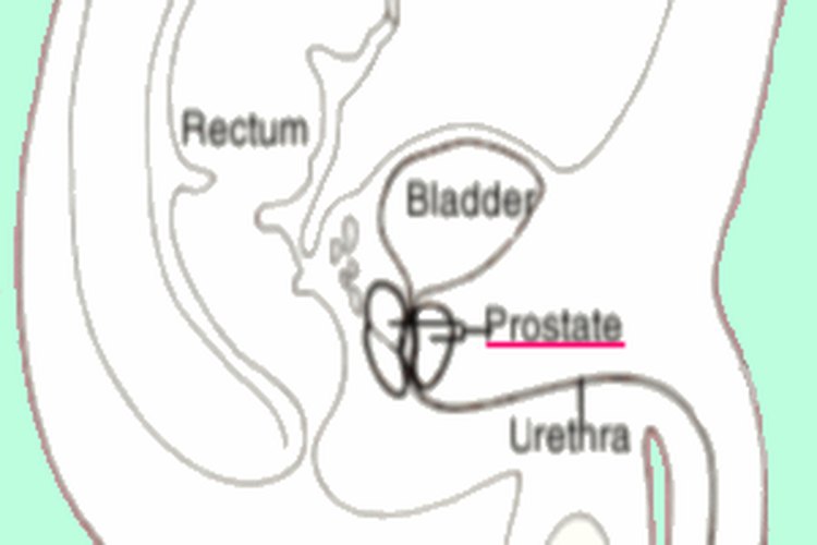 La prostatitis se produce cuando la próstata se inflama.